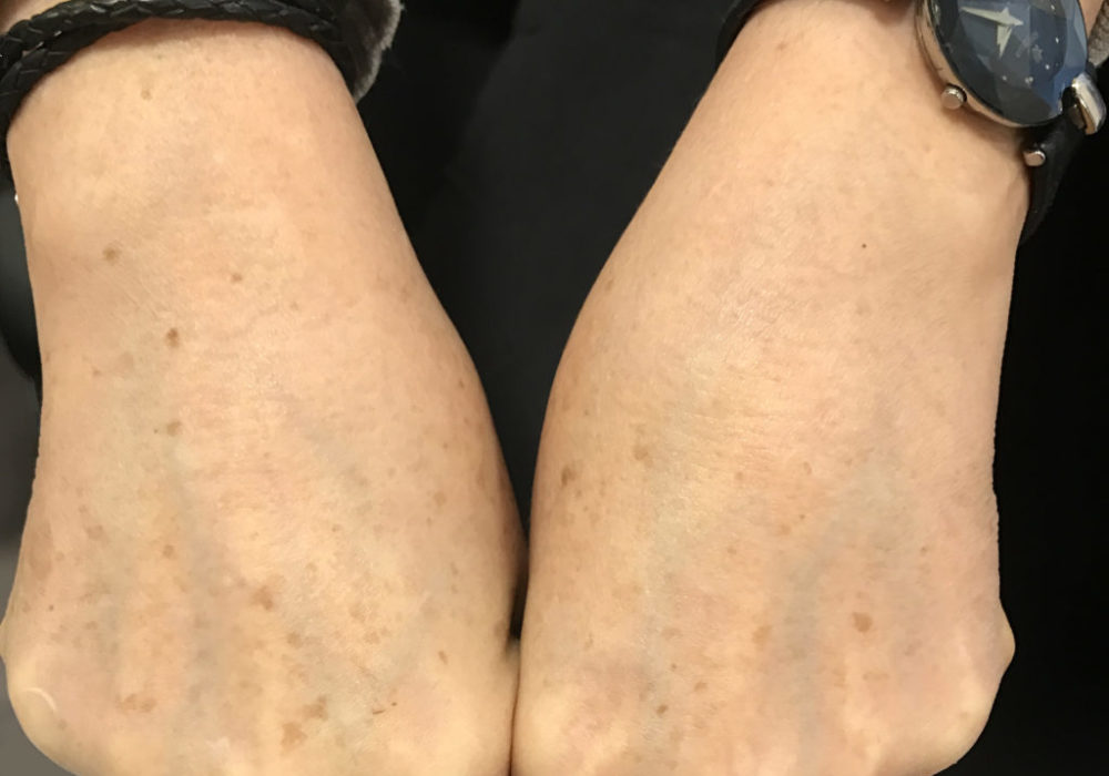 Laser Treatment Before