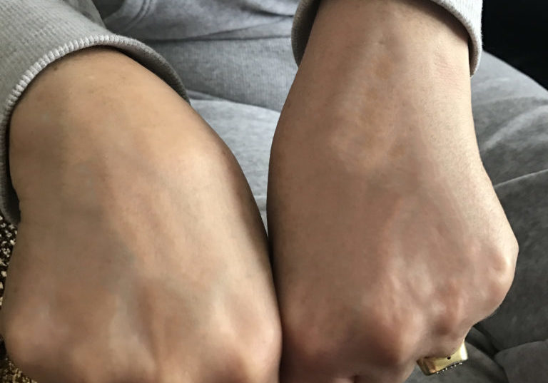 Laser Treatment Before