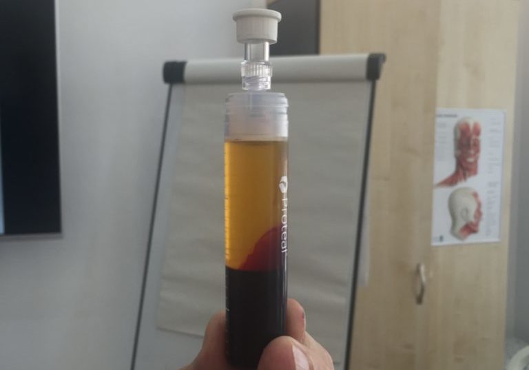 Platelet Rich Plasma