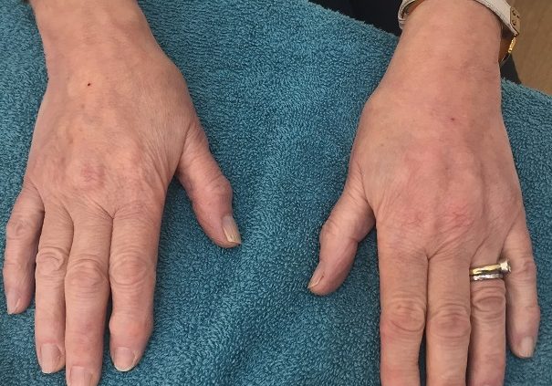 Fillers After